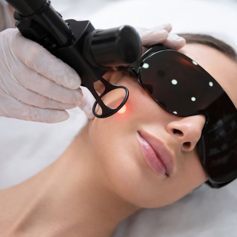 CO2 Resurficing laser acne scar deep wrinkles Bristol