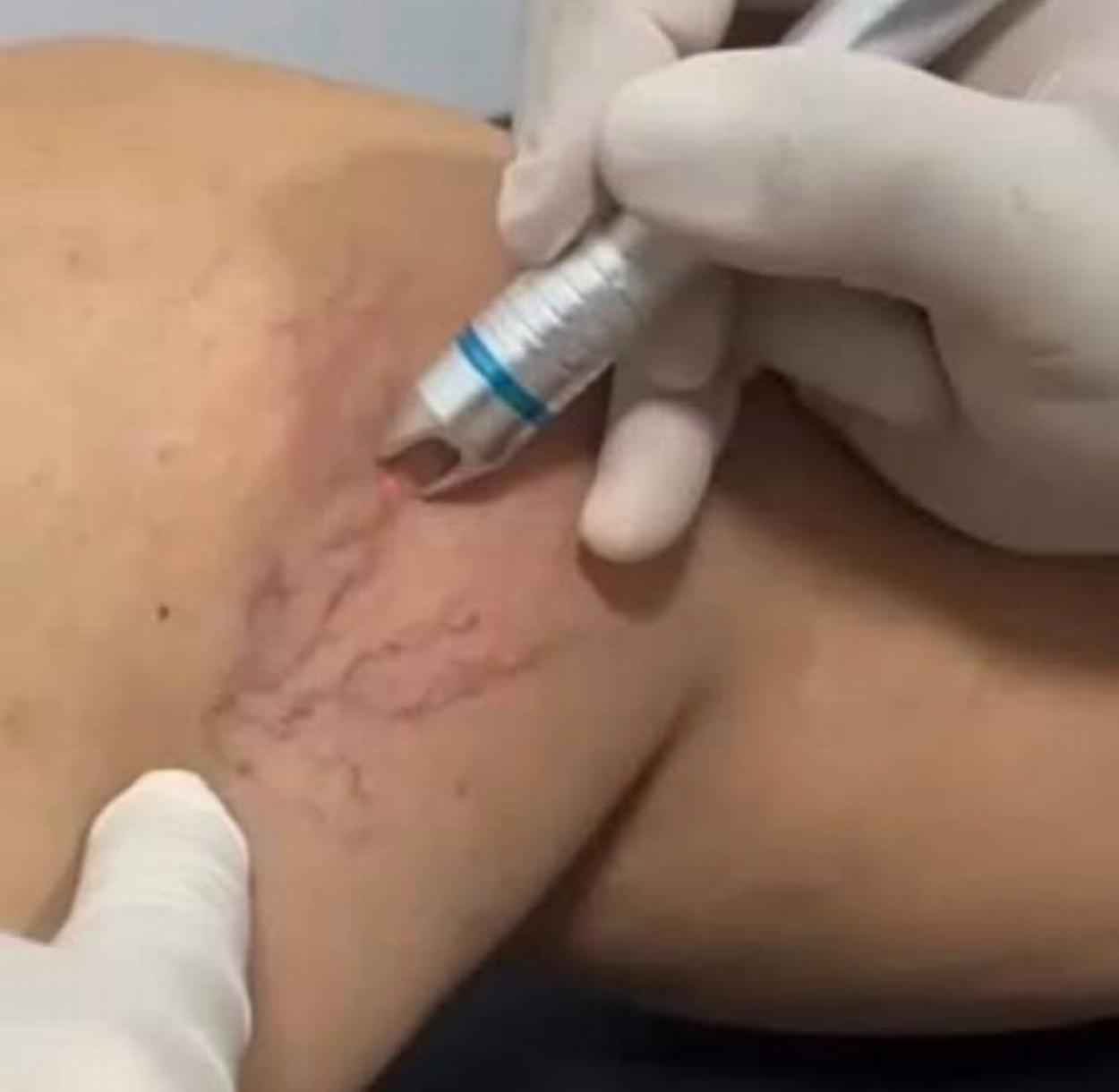 thread vein varicose vein removal bristol